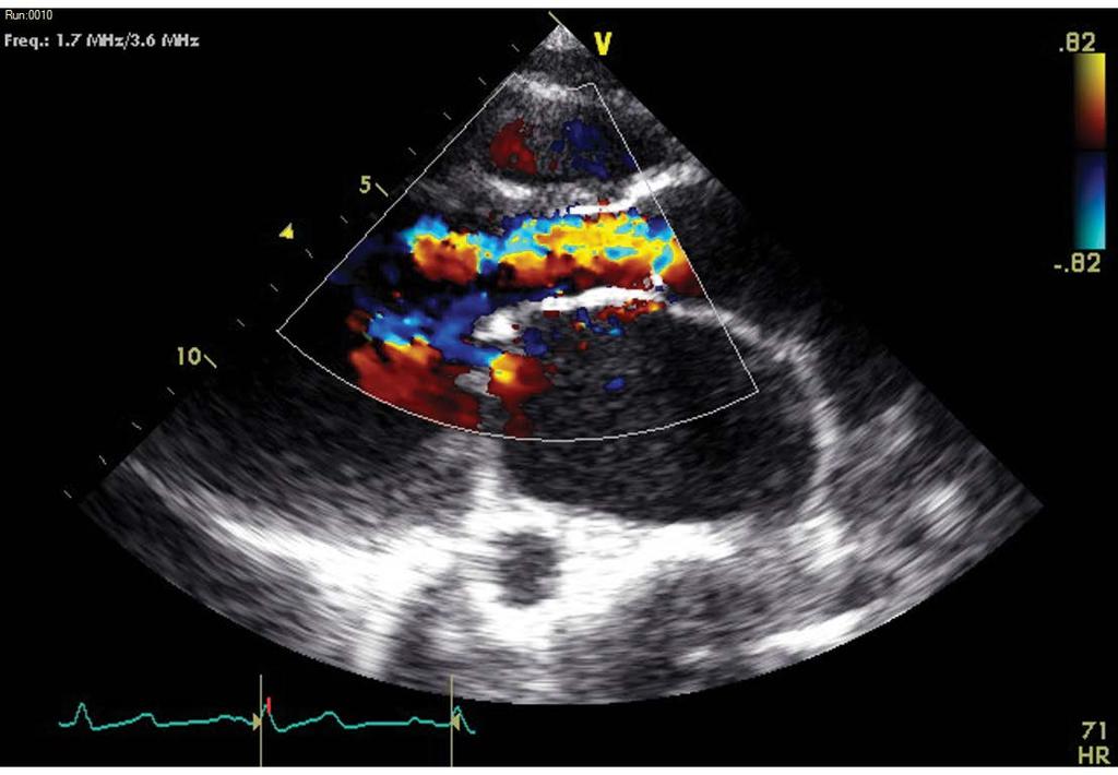 83 cm 2 /m 2 ) (Figure 2). Figure 2. Severely regurgitant aortic valve.