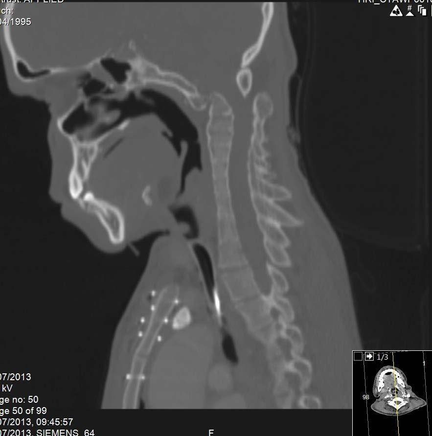 Figure 5. Reconstructed CT image demonstrating the union of the cervical vertebrae. Figure 6. Reconstructed CT image demonstrating the union of the cervical vertebrae. His pre-discharge echocardiography demonstrated normally functioning aortic and mitral prostheses.