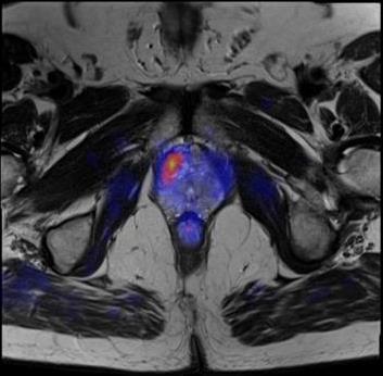 PET/CT in Prostate Cancer Recurrence: Imaging with C-11 Choline C-11 choline is a radiolabeled analog of choline, which is essential for cell membrane synthesis.