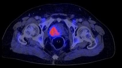 PET/CT in Prostate Cancer for