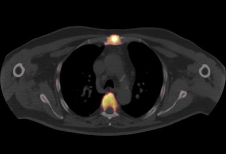 PET/CT in Prostate Cancer: Restaging CASE EXAMPLE: 77-year-old man with a history of prostate cancer; high Gleason score of 8, rising prostate-specific