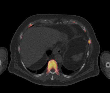 increased tracer update in the center body of the sternum (left panel), corresponding to a rounded sclerotic lesion on the CT image F-18 NaF-PET/CT