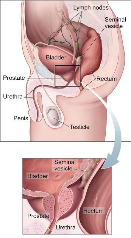 Prostate Cancer: Definition Cancer that forms in tissues of the prostate Prostate cancer usually occurs in older men A healthy prostate is about the size of