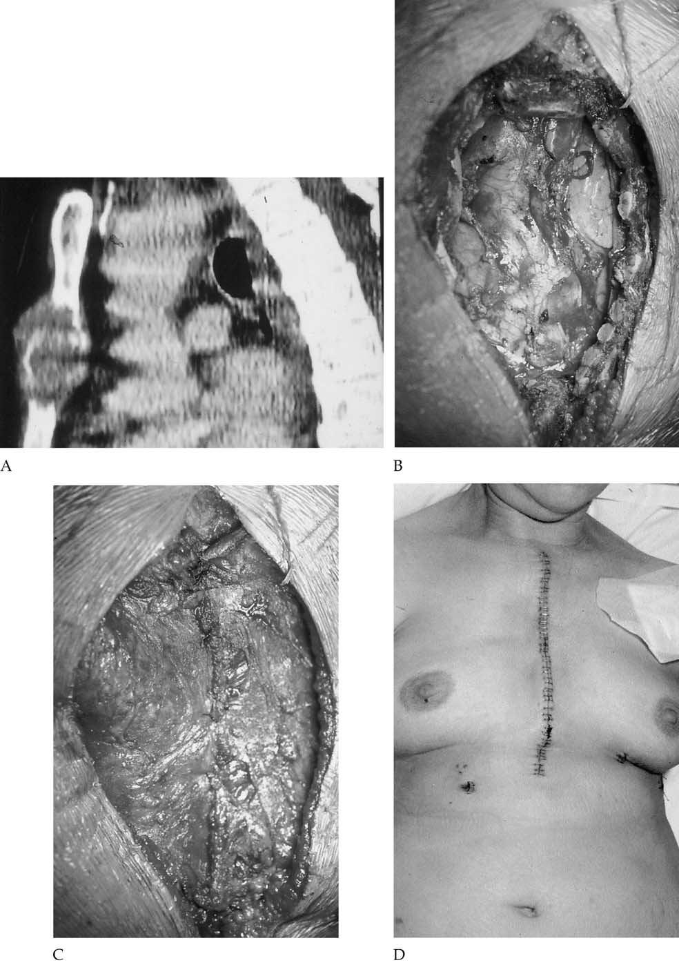 Ann Thorac Surg CHAPELIER ET AL 2004;77:1001 7 STERNAL RESECTION FOR MALIGNANT TUMORS 1003 Fig 1. Leiomyosarcoma of the sternal body in a 49-year-old female.