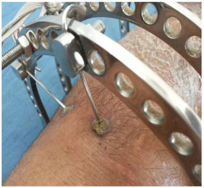 Figure 1 Pin tract infection in patient treated for non union tibia with Ilizarov ring fixator