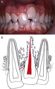 Malmgren et al. tooth and transverse horizontally through the attached portion of the interdental gingiva and insert into the cervical cementum of the adjacent tooth (12).