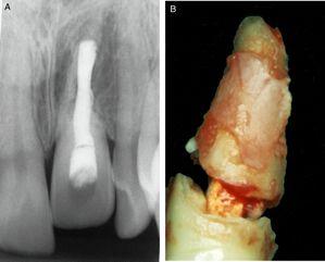 Alveolar bone development after decoronation of ankylosed teeth Fig. 2. An ankylosed tooth to be extracted. A. Radiograph of ankylosed tooth in infraposition taken before surgery. B.