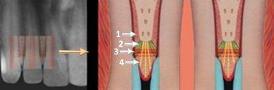 Malmgren et al. Fig. 4. Graphic illustration of a root-filled replanted incisor with optimal periodontal healing. 1. Sharpey s fibers (black). 2. Dental periosteal fibers (green). 3.