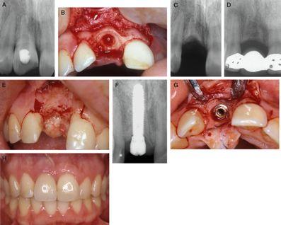 B. A mucoperiosteal flap has been raised and the crown has been removed. The coronal part of the root is reduced to a level about 1.5 2.0 mm below the alveolar crest.