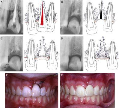 Alveolar bone development after decoronation of ankylosed teeth Fig. 6. Decoronation of an ankylosed maxillary central incisor in a 13-year-old boy. A-B.