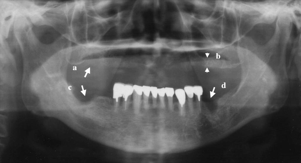 molar area, (b) Sinus height reduced to 7 mm, (c) & (d) Radiolucent areas at