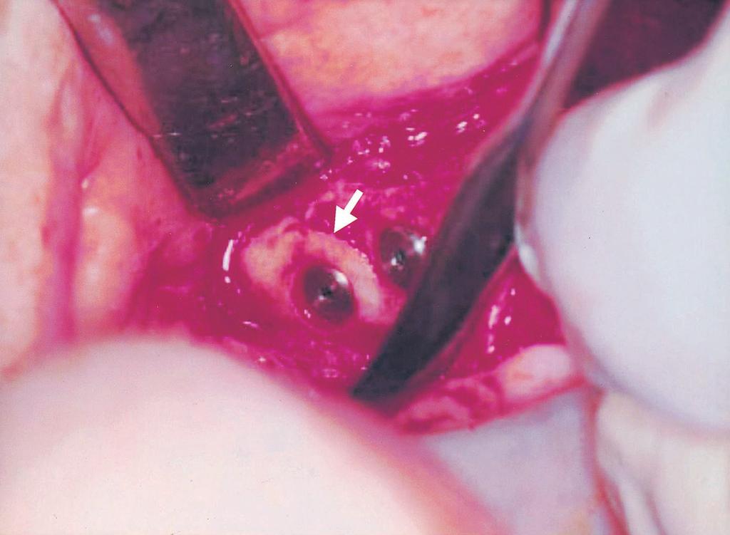 2 Inlay bone graft at the right side of the maxillary alveolar ridge with