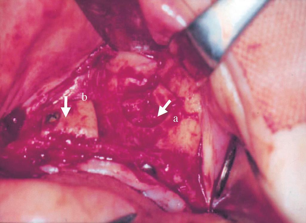 view of veneer graft fixed with a miniscrew. Fig.