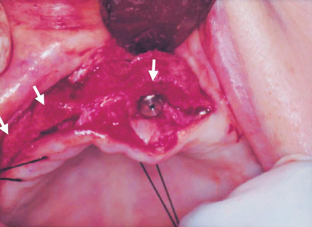 231 Fig. 7 An additional implant fixture is placed in the maxilla, at the left-side canine area. Arrows indicate the augmented bone volume at the area of the veneer grafts. (10).