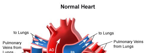 Elevated pulmonary artery pressures High RV
