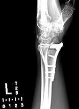LB How to Treat a Distal Radius Fx Need to restore