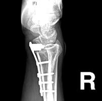 an unreduced fracture Need to maintain the