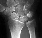 Capsular injuries and potential for scarring Neurologic injuries Joint widening