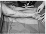 Complications Compartment Syndrome Life and limb threatening From increased tissue
