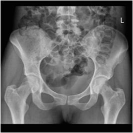 Bone is opaque on XR Appears smooth, any breaks in continuity indicate injury View from many angles Never diagnose based solely on XR,