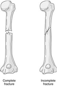 the joint Epiphysis Physis on one side, articular cartilage on the other; secondary ossification center Physis Growth plates Periosteum
