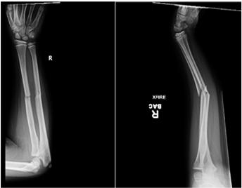 A. Right midshaft both bone forearm fracture with 50% dorsal displacement and 30% apex volar angulation B.