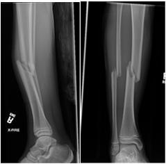 Right midshaft both bone forearm fracture with angulation and displacement Name this Fracture What should be included when speaking