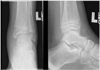 Left distal tibia SH 2 fracture Supracondylar Humerus Fractures 60% of pediatric elbow fractures