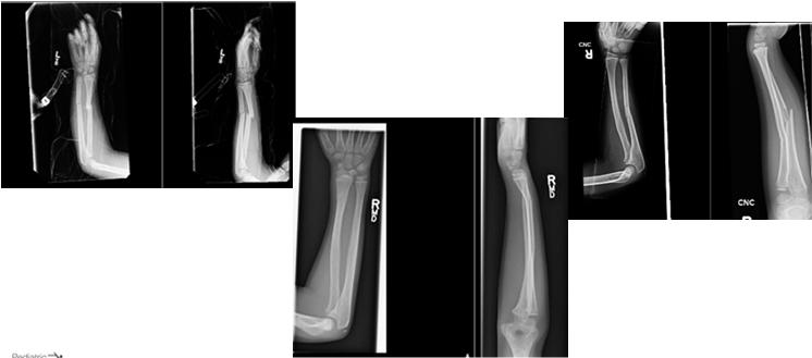 Both Bone Forearm Fractures Both Bone Forearm Fractures 40 50% of all childhood fractures More common distally Midshaft fractures are the most common site of refracture