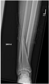 fractures Toddler s Fracture Specialized case