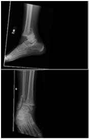 ambulate in cast Ankle Fractures Common in the