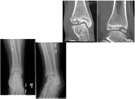 Tillaux Fracture Type of SH 3 fracture Occurs in ages