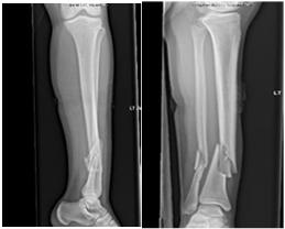 age is 13 Ankle Fractures Ankle Fractures Depends on
