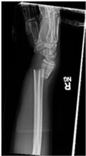 L SH 2 distal tibia and fibula fracture B.