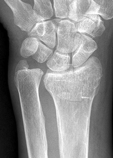 86 Fig. 4. Initial radiographs (A-C) of 79-year-old man were showing intra-articular fracture of left distal radius fracture.