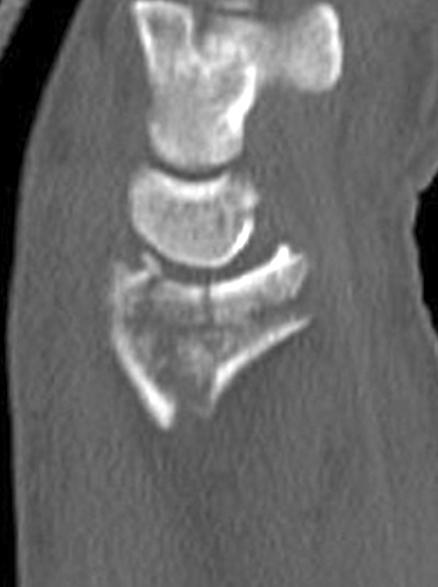 Dorso-ulnar cortical corner fracture of the distal radius was not found on