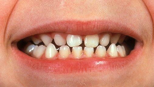 The first set of teeth we have as children are called milk teeth.