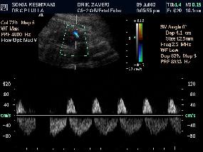 Protok kroz fetalnu aortu odražava srčani output i periferni otpor. Dijastolni protok prisutan u 2. i 3. trimestru, PI konstantan ukazuje na protok u abdominalne organe i donje ekstremitete.