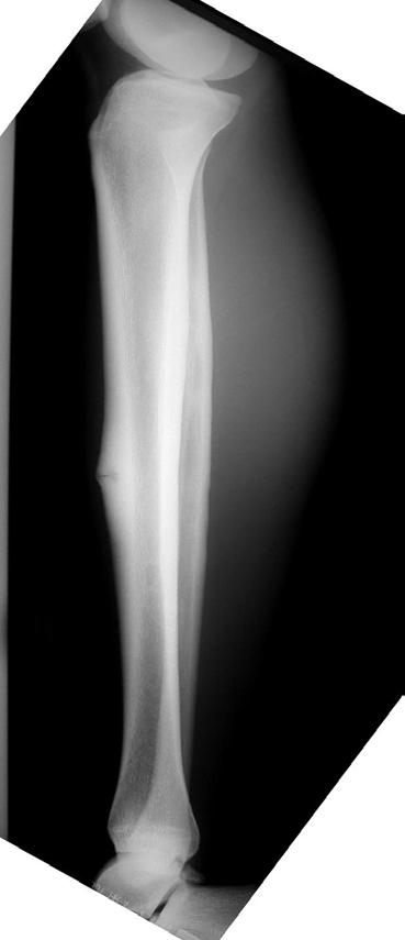 A B Fig. 1. Lateral radiograph of anterior mid-tibia stress fracture (A).