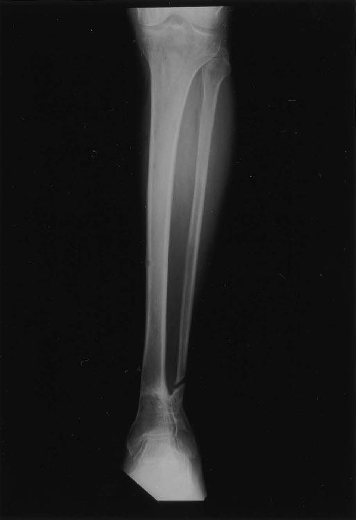 DISCUSSION The management of malunion and nonunion of the tibia is one of the most challenging problems facing the orthopaedic surgeon.