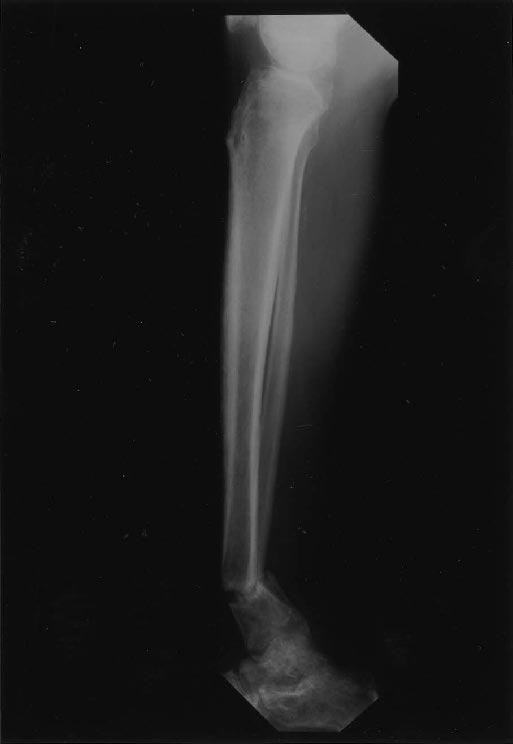 Reasons for failure of bony healing at the fracture site include the amount of initial fracture displacement, the poor condition of the surrounding soft tissue envelope, and the microvascular