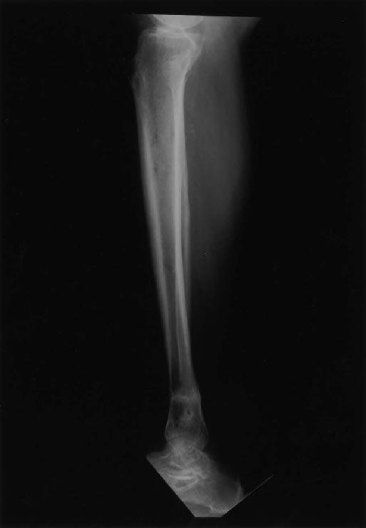 J Orthop Trauma Volume 17, Number 8, September 2003 Spatial Frame Correction of Tibial Deformity FIGURE 6.