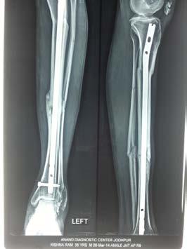 fracture tibia.