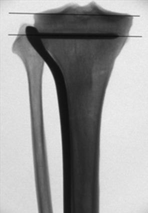 Alternate Guideline to Assess Coronal Alignment reported. The main problem with this technique, however, is malalignment.