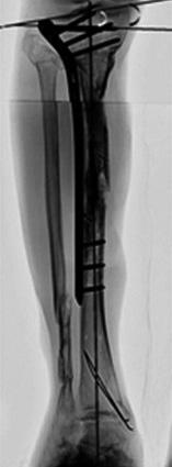 With this objective in mind, we measured the angle between the proximal most locking screw through LCP PLT and the joint line in normal adult tibia of cadaver limbs [this angle was termed as the
