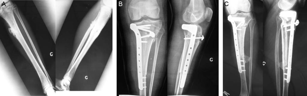 Intercalary defects reconstruction of the femur and tibia 515 Table 2 Peri- and postoperative data.