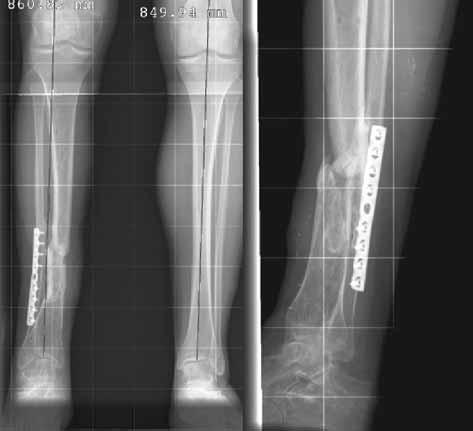 PARTIAL FIBULECTOMY AND ILIZAROV FRAME 631 The records of 28 patients (21 male, 7 female) treated between 2001 and 2004 for a delayed union or nonunion of the tibial shaft were retrospectively