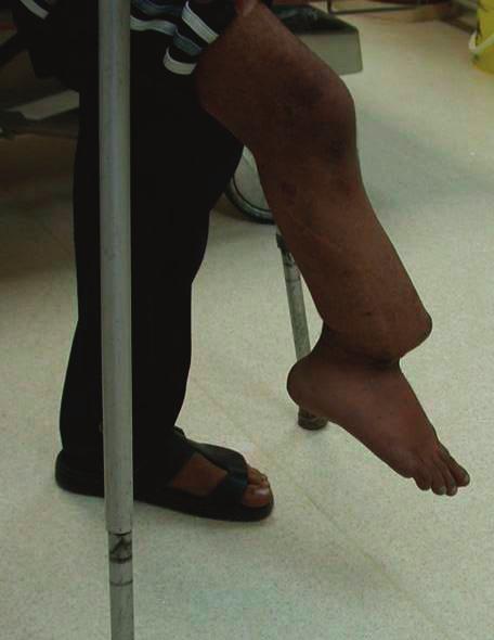 Congenital Pseudarthrosis of the Tibia 69 Case Report A sixteen-year-old adolescent was diagnosed at age of one and halfyear with CPT.