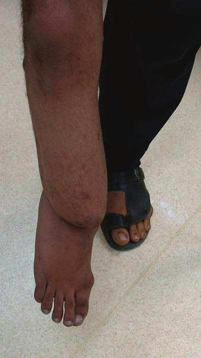 Examination revealed clear stigmata of neurofibromatosis, with severe angulations of the tibia apex anterior 90 and medial 70 with leg length discrepancy (LLD) of 17 cm (Fig. 1A, B, C).