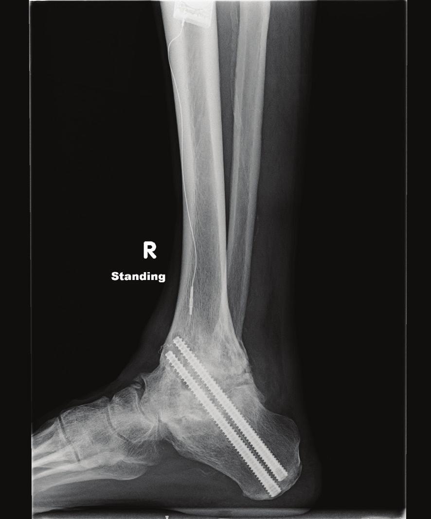 3 This report presents two cases with diabetic patients who both underwent revision TTC fusion with Dynanail to treat failed hindfoot arthrodesis. Performing Surgeon Dr. L.